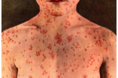 Interior Health closely monitoring outbreak of measles in Fraser Valley